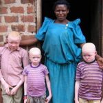 Albinos in Uganda