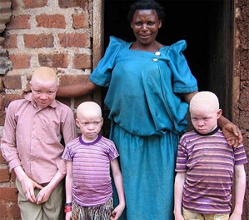 Albinos in Uganda